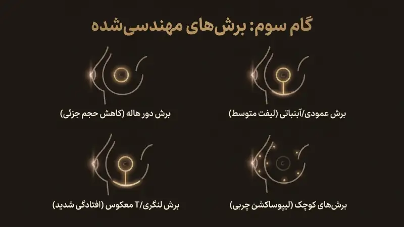 . ایجاد برش‌های جراحی؛ یکی از مهم‌ترین مراحل انجام عمل ماموپلاستی
