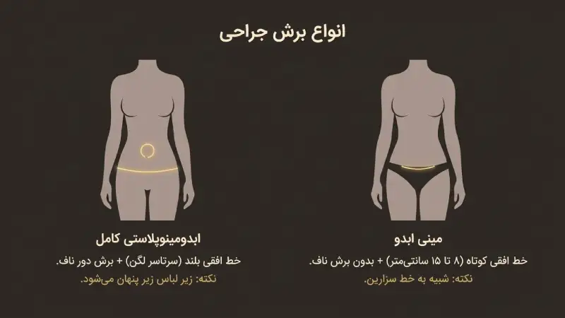 جای بخیه عمل ابدومینوپلاستی کامل