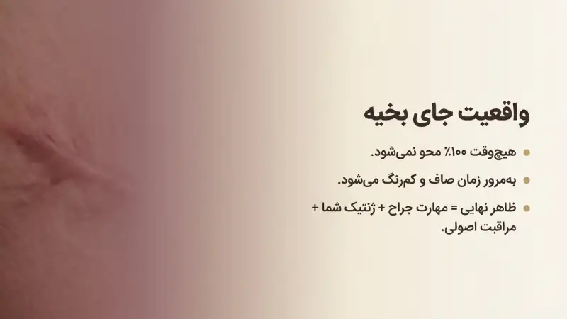 جای بخیه عمل ابدومینوپلاستی چه شکلی است و کی از بین میرود؟
